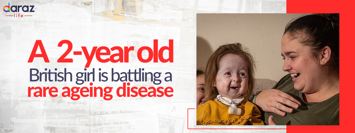  This 2-year old maybe the only person in the world  with this rare ageing disease