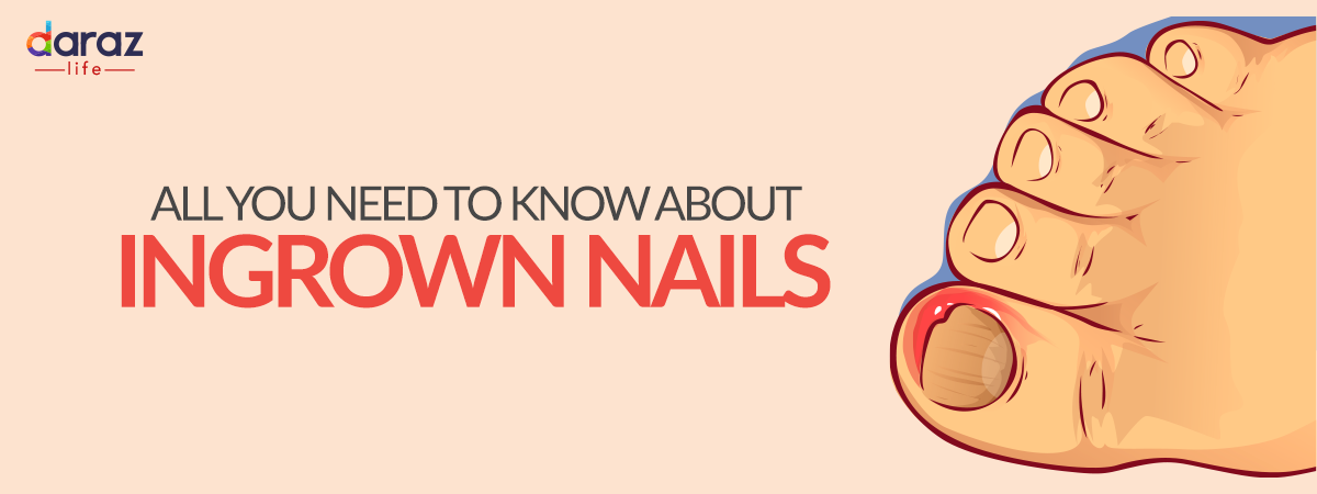  All You Need to Know About Ingrown Nails